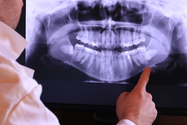 Best Emergency Tooth Extraction in Montecito, CA